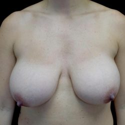 Breast Reduction Before & After Patient #24777