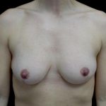 Breast Reduction Before & After Patient #24777