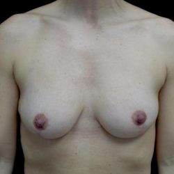 Breast Reduction Before & After Patient #24777