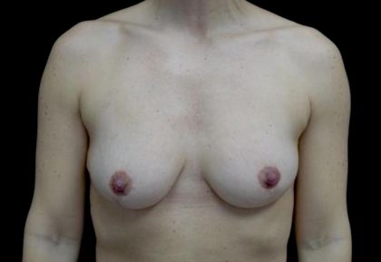 Breast Reduction Before & After Patient #24777
