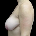 Breast Reduction Before & After Patient #24777