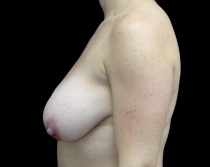 Breast Reduction Before & After Patient #24777