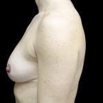 Breast Reduction Before & After Patient #24777
