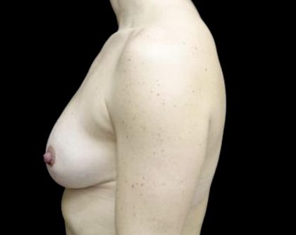 Breast Reduction Before & After Patient #24777