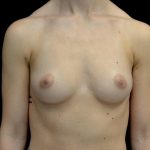 Breast Augmentation (Implants) Before & After Patient #24769
