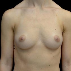 Breast Augmentation (Implants) Before & After Patient #24769