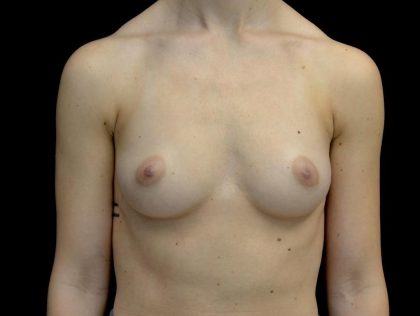 Breast Augmentation (Implants) Before & After Patient #24769