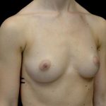 Breast Augmentation (Implants) Before & After Patient #24769