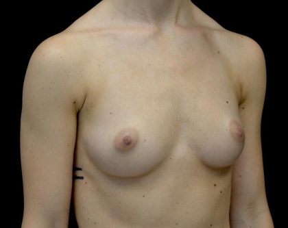 Breast Augmentation (Implants) Before & After Patient #24769