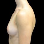 Breast Augmentation (Implants) Before & After Patient #24769