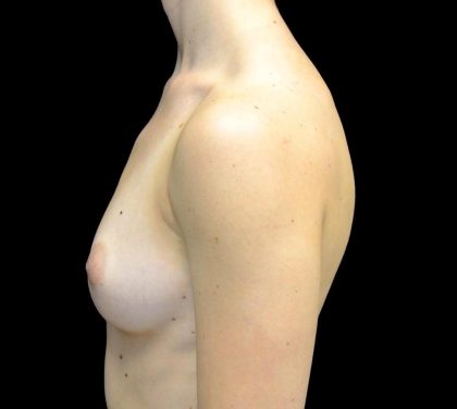 Breast Augmentation (Implants) Before & After Patient #24769