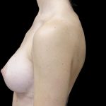 Breast Augmentation (Implants) Before & After Patient #24769
