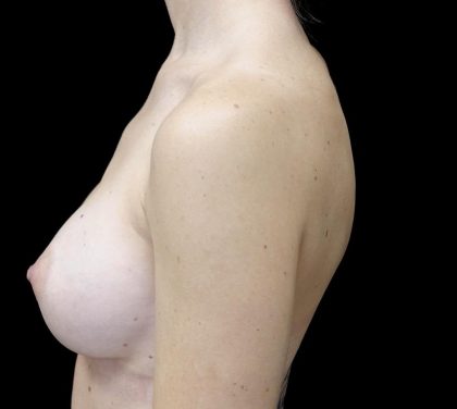 Breast Augmentation (Implants) Before & After Patient #24769
