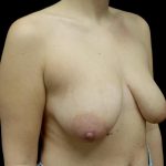 Breast Lift Before & After Patient #24770
