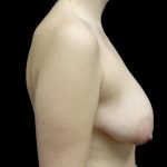 Breast Lift Before & After Patient #24770