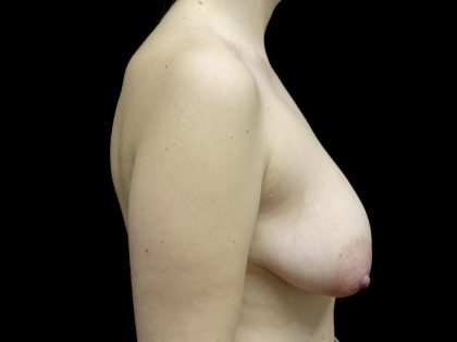 Breast Lift Before & After Patient #24770