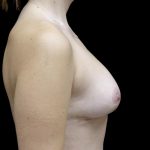 Breast Lift Before & After Patient #24770