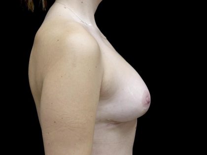 Breast Lift Before & After Patient #24770