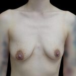 Breast Augmentation (Implants) Before & After Patient #24771