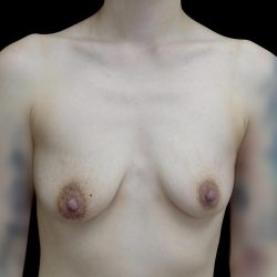 Breast Augmentation (Implants) Before & After Patient #24771