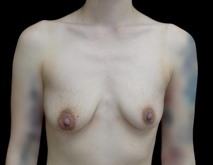 Breast Augmentation (Implants) Before & After Patient #24771
