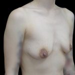 Breast Augmentation (Implants) Before & After Patient #24771