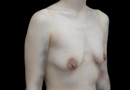Breast Augmentation (Implants) Before & After Patient #24771