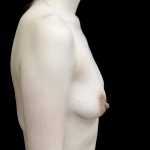 Breast Augmentation (Implants) Before & After Patient #24771