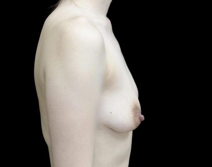 Breast Augmentation (Implants) Before & After Patient #24771