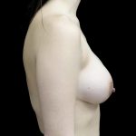 Breast Augmentation (Implants) Before & After Patient #24771