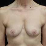Breast Lift Before & After Patient #24772