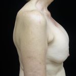 Breast Lift Before & After Patient #24772