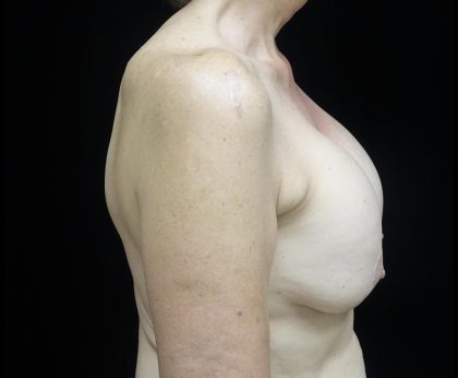 Breast Lift Before & After Patient #24772