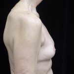 Breast Lift Before & After Patient #24772