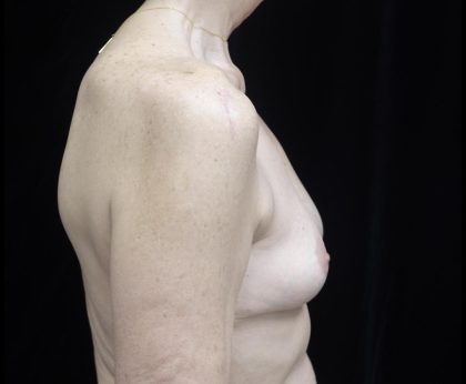 Breast Lift Before & After Patient #24772