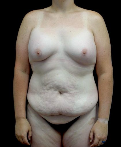 Breast Augmentation (Fat Transfer) Before & After Patient #24773
