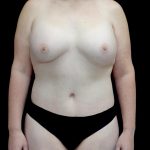 Breast Augmentation (Fat Transfer) Before & After Patient #24773