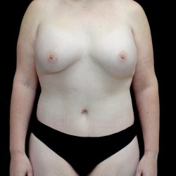 Breast Augmentation (Fat Transfer) Before & After Patient #24773