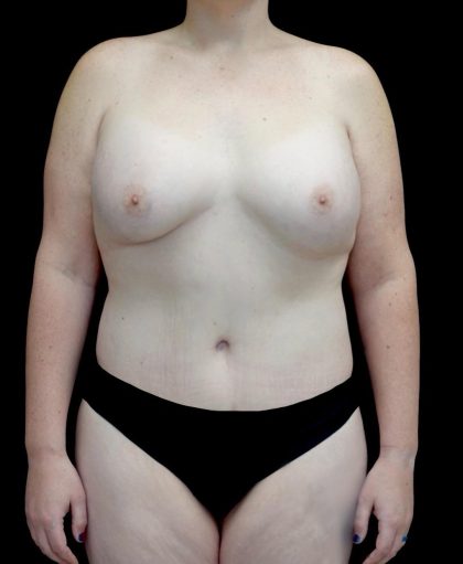 Breast Augmentation (Fat Transfer) Before & After Patient #24773