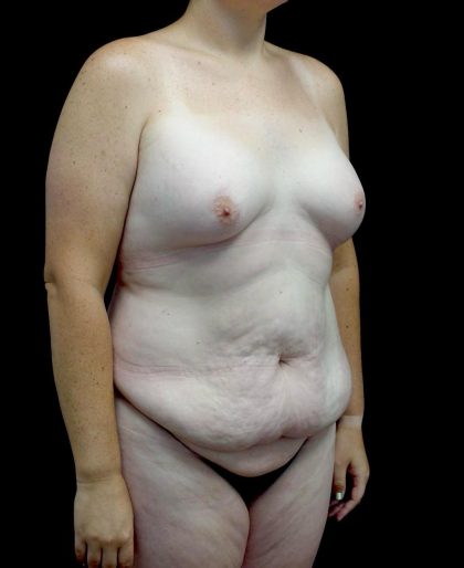 Breast Augmentation (Fat Transfer) Before & After Patient #24773
