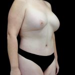 Breast Augmentation (Fat Transfer) Before & After Patient #24773