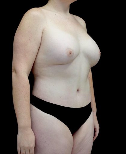 Breast Augmentation (Fat Transfer) Before & After Patient #24773