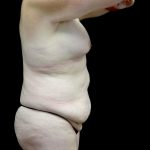 Breast Augmentation (Fat Transfer) Before & After Patient #24773