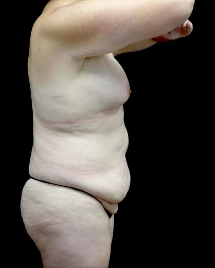 Breast Augmentation (Fat Transfer) Before & After Patient #24773