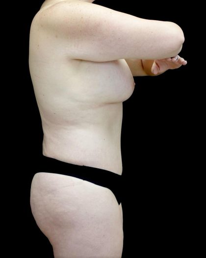 Breast Augmentation (Fat Transfer) Before & After Patient #24773