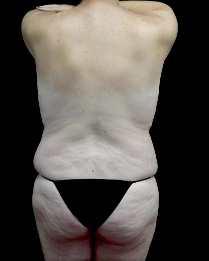 Breast Augmentation (Fat Transfer) Before & After Patient #24773