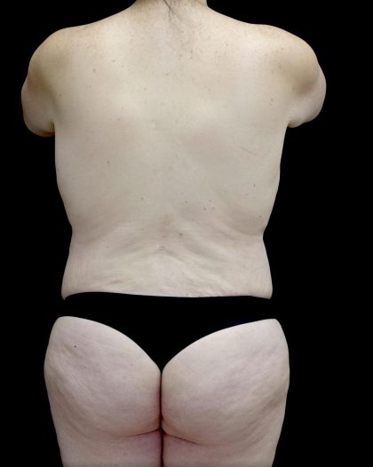 Breast Augmentation (Fat Transfer) Before & After Patient #24773