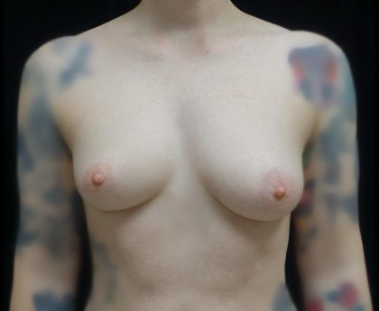 Breast Augmentation (Fat Transfer) Before & After Patient #24774