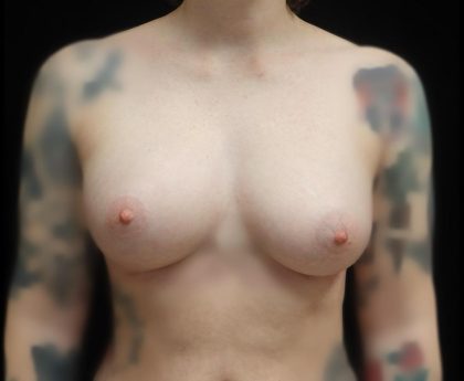 Breast Augmentation (Fat Transfer) Before & After Patient #24774
