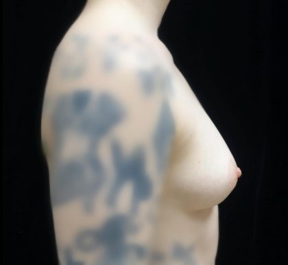 Breast Augmentation (Fat Transfer) Before & After Patient #24774